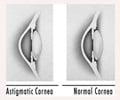 Astigmatism