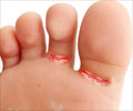 Athlete's Foot - Causes - Symptoms - Treatment - FAQs Athlete's Foot - Causes - Symptoms - Treatment - FAQs