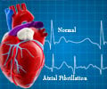 Atrial Fibrillation - Causes, Symptoms, Diagnosis, Treatment, Complication, Risks Atrial Fibrillation - Causes, Symptoms, Diagnosis, Treatment, Complication, Risks