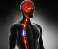 Autonomic Dysreflexia - Causes, Symptoms, Diagnosis, Treatment, Prevention Autonomic Dysreflexia - Causes, Symptoms, Diagnosis, Treatment, Prevention