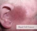 Basal Cell Cancer-Risk Factors-Symptoms–Diagnosis–Treatment–Prognosis-Prevention Basal Cell Cancer-Risk Factors-Symptoms–Diagnosis–Treatment–Prognosis-Prevention