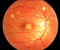 Best Disease / Vitelliform Macular Dystrophy - Symptoms – Diagnosis - Treatment