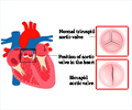 Bicuspid Aortic Valve - Causes, Symptoms, Complications, Diagnosis, Treatment, Prevention & Precautions Bicuspid Aortic Valve - Causes, Symptoms, Complications, Diagnosis, Treatment, Prevention & Precautions