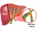 Bile Duct Cancer | Cholangiocarcinoma - Causes, Risk Factors, Symptoms,  Diagnosis, Stages, Treatment, Support Groups