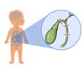 Biliary Atresia - Types, Causes, Symptoms, Diagnosis, Treatment & Prevention