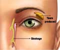 Blocked Tear Duct