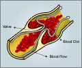 Blood Clots - Causes Symptoms Diagnosis Treatment Prevention