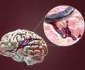 Brain Hemorrhage | Intracranial Hemorrhage - Causes, Symptoms, Diagnosis, Treatment & Prevention