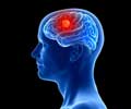 Brain Metastasis - Causes, Symptoms, Diagnosis and Treatment Brain Metastasis - Causes, Symptoms, Diagnosis and Treatment