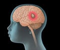 Brain Tumor in Children - Types, Causes, Symptoms, Diagnosis & Treatment