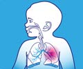Bronchopulmonary Dysplasia | Respiratory Insufficiency - Causes, Clinical features, Management