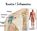 Bursitis / Inflammation of the Bursa