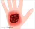 Buruli Ulcer - Causes, Symptoms, Diagnosis, Treatment, Prognosis, Health Tips