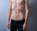 Cachexia - Causes Symptoms Diagnosis Treatment & Prevention