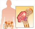 Bone Cancer - Causes, Symptoms, Signs, Diagnosis, Treatment, Prevention, Health Tips Bone Cancer - Causes, Symptoms, Signs, Diagnosis, Treatment, Prevention, Health Tips