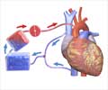 Cardiopulmonary Bypass - Risk & Complications