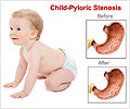 Pediatric Pyloric Stenosis / Infantile Hypertrophic Pyloric Stenosis (IHPS) Pediatric Pyloric Stenosis / Infantile Hypertrophic Pyloric Stenosis (IHPS)
