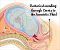 Intra-amniotic Infection Intra-amniotic Infection