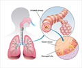 Chronic Bronchitis - Causes, Symptoms, Diagnosis, Treatment & Prevention