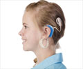 Cochlear Implants Cochlear Implants