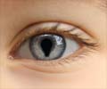 Coloboma - Causes, Symptoms, Diagnosis, Treatment & Prevention