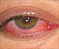 Corneal Ulcer