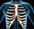 Costochondritis - Causes, Symptoms, Diagnosis, Treatment, Prevention & Prognosis Costochondritis - Causes, Symptoms, Diagnosis, Treatment, Prevention & Prognosis