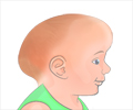 Craniosynostosis - Types, Causes, Symptoms, Diagnosis, Treatment & Prevention Craniosynostosis - Types, Causes, Symptoms, Diagnosis, Treatment & Prevention