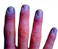 Cyanosis - Causes, Diagnosis and Treatment