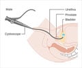 Cystoscopy