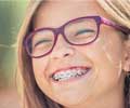 Dental Braces