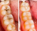 Prevent Tooth Decay in Children by Using Dental Sealants