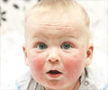 Dermatitis - Causes, Types, Clinical Features, Diagnosis, Treatment & Prevention