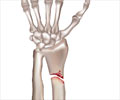 Distal Radius Fracture - Types, Symptoms, Treatment, Exercises, Physiotherpy Products 