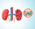 Drug-Induced Kidney Disease | Nephrotoxicity
