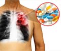 Drug-induced Pulmonary Diseases - Types, Symptoms and Treatment