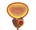Drugs for Prostate Cancer - Treatment, Side Effects & Precautions