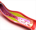 Dyslipidemia | Lipid Disorders - Levels, Symptoms, Signs, Diagnosis, Treatment and Prevention