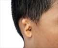 3D-Printed Ears: A Solution for Congenital Ear Defects