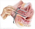 Endometrial Biopsy
