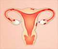 Endometriosis - Causes, Symptoms, Diagnosis, Treatment