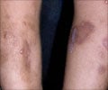 Epidermolysis bullosa-Causes-Symptoms-Diagnosis-Treatment-Prognosis-Complications Epidermolysis bullosa-Causes-Symptoms-Diagnosis-Treatment-Prognosis-Complications