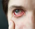 Eye Allergies | Ocular Allergies - Types, Causes, Symptoms, Diagnosis, Complications, Treatment and Prevention Eye Allergies | Ocular Allergies - Types, Causes, Symptoms, Diagnosis, Complications, Treatment and Prevention
