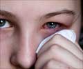Eye Infections | Ocular Infections - Causes Symptoms Diagnosis Treatment