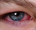 Eye Redness
