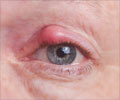 Eyelid Bump | Eyelid Swelling - Symptom Evaluation