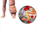 Symptoms of Filariasis