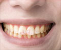 Fluorosis - Causes, Symptoms, Diagnosis, Treatment, Prevention Fluorosis - Causes, Symptoms, Diagnosis, Treatment, Prevention