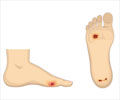 Foot Ulcer - Causes, Types, Symptoms, Treatment & Prevention