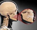 Broken Jaw | Mandibular Fracture - Types, Causes, Symptoms, First Aid, Treatment